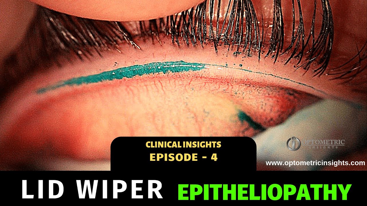 Lid Wiper Epitheliopathy Episode 4 YouTube