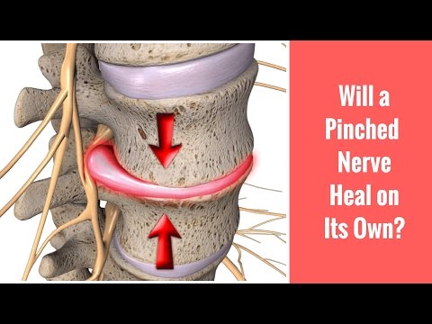 Video: Pinched Nerve In The Spine - Causes, Symptoms And Treatment