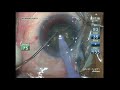 Unedited phaco chopping in a hard brown cataract dr manas nath