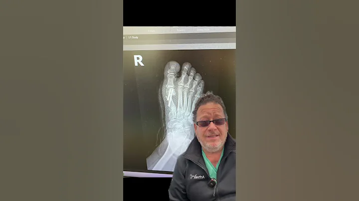 Got Bunions? Check Out This Minimally Invasive Procedure!- Dr. Bernstein