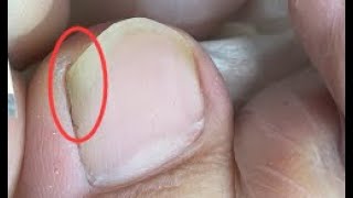 Satisfying toenail repair skill
