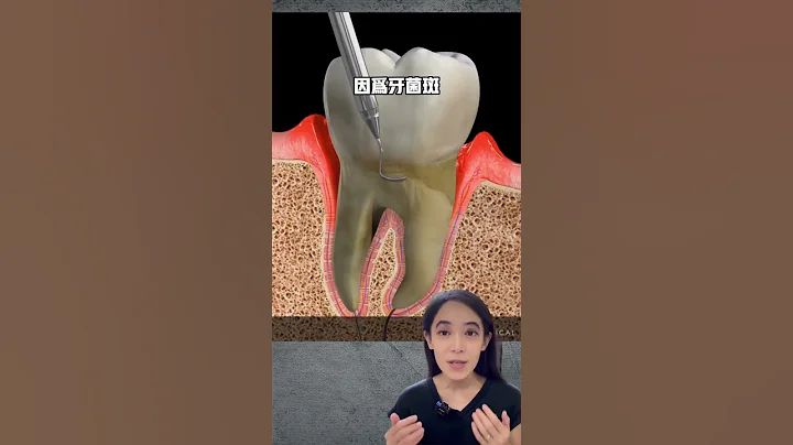 油拔法可以治疗牙龈萎缩吗#洗牙#牙周手术 - 天天要闻