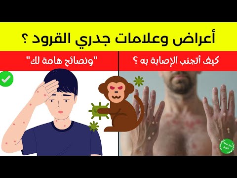 أعراض جدري القرود 6 علامات تنذرك به وكيفية الوقاية من إصابة جدري القرود