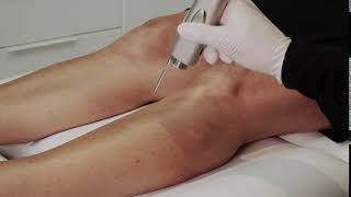 Comment Se Débarrasser Des Poils Grâce À Lépilation Définitive Au Laser