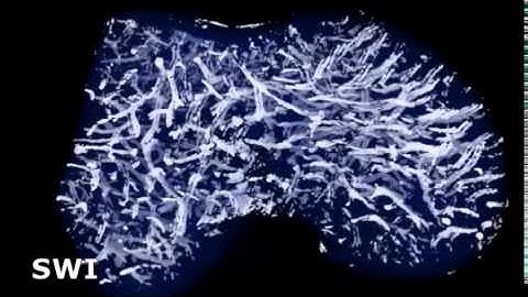 Improved Visualization of Cartilage Canals Using Quantitative Susceptibility Mapping