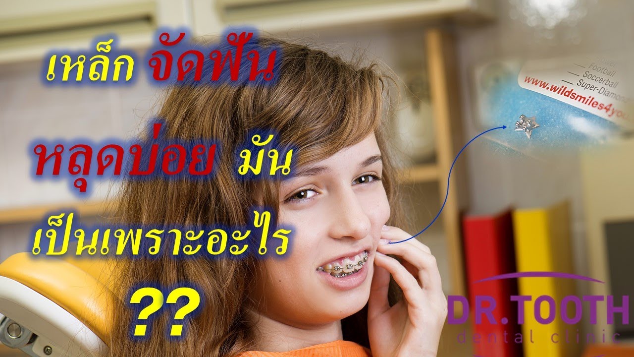 เหล็กจัดฟันหลุดบ่อย มันเป็นเพราะอะไร ?? #จัดฟันที่ไหนดี #จัดฟัน #จัดฟันครั้งแรก #จัดฟันรอบสอง 