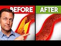 Best Nutrients to Remove Plaque from Arteries