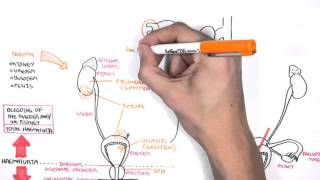 Causes of Haematuria