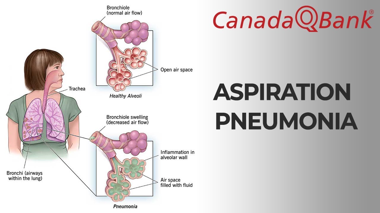 Aspiration Pneumonia 