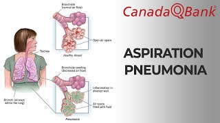 Aspiration Pneumonia screenshot 1