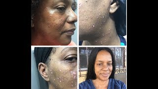 LASER MOLE REMOVAL (Full Procedure) and TALK THROUGH with the Doctor