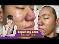 Remove super bis acne| Điều trị mụn hiệu quả số 1 TPHCM| Hiền Vân Spa | Trần Văn Nhân |538