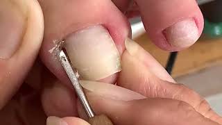 Những Ca Cắt Da Lấy Khoé Phải Nói Là Cắt Đến Đâu Đã Đến Đó