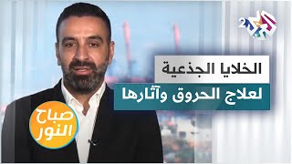 الخلايا الجذعية واستخداماتها في علاج الحروق وآثارها