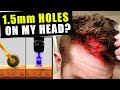 I Cut Thousands Of 1.5 Millimetre Holes In My Head Every Week To Prevent Hair Loss