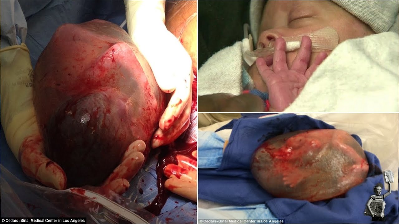 Baby born with amniotic sac intact, placenta and umbilical ...