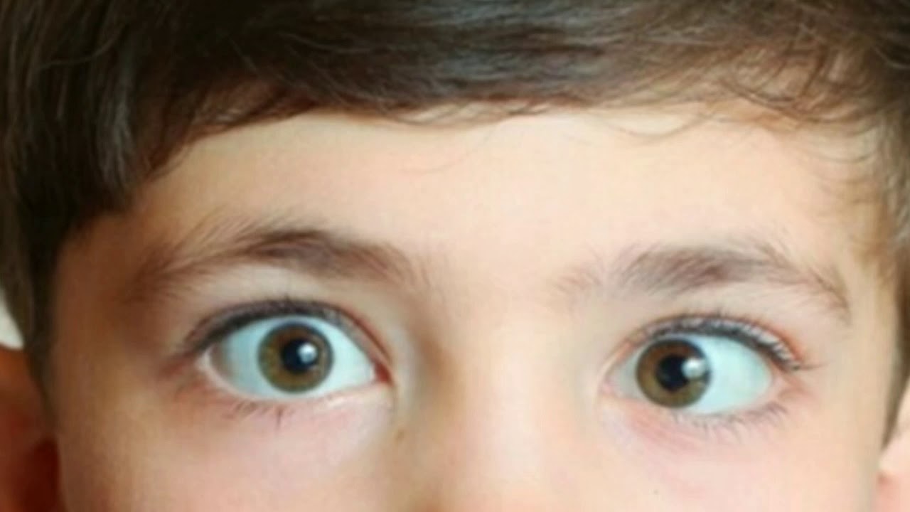 Squint also called strabismus, is an eye condition where the eyes do not lo...