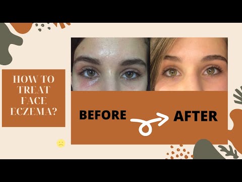 How to treat Face Eczema?- ازاي عالجت وشي من الاكزيما ؟