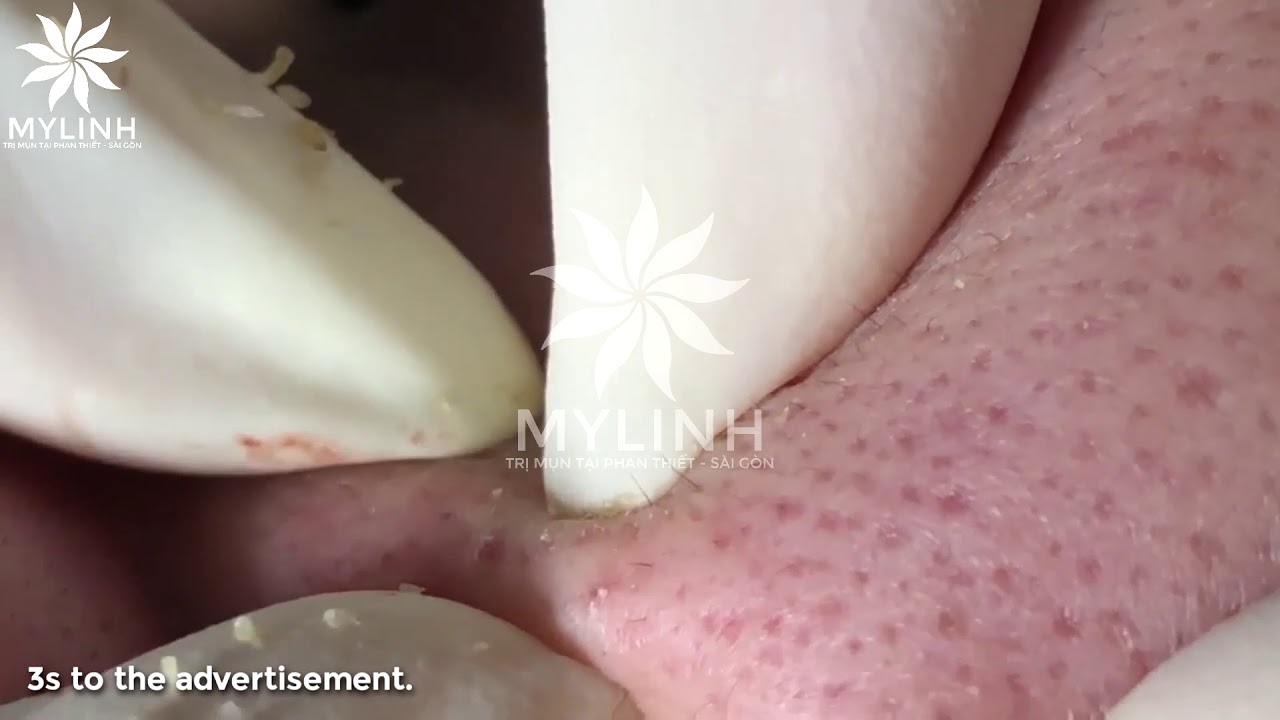 BLACKHEADS AND ACNE REMOVAL #21 | Nặn mụn ẩn dưới da, mụn đầu đen | 黑頭和粉刺去除 | 0934000075