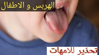 تحذير لكل ام ‼️ الهربس من واقع تجربتي كأم متسكتيش لو شفتي الأعراض دى ع أولادك.