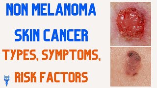 NON MELANOMA SKIN CANCER | Types, Symptoms, Risk Factors, Treatment