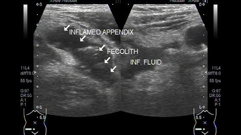 The Scanning of the inflamed Appendix with fecolith in its interior.