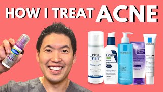 How I Treat Acne: An Overview of Treatment Options