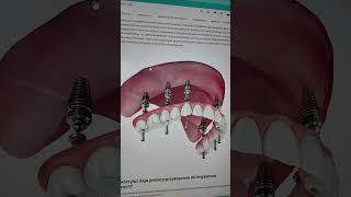 Stabilna Proteza? Implanty Śmiechbezobaw Ęby