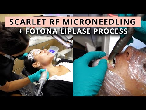 Watch Scarlet RF Microneedling & Fotona 4D Laser Treatment, Fotona LipLase With Me!