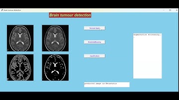 Brain tumor detection and classification with various state analysis using deep learning algorithm
