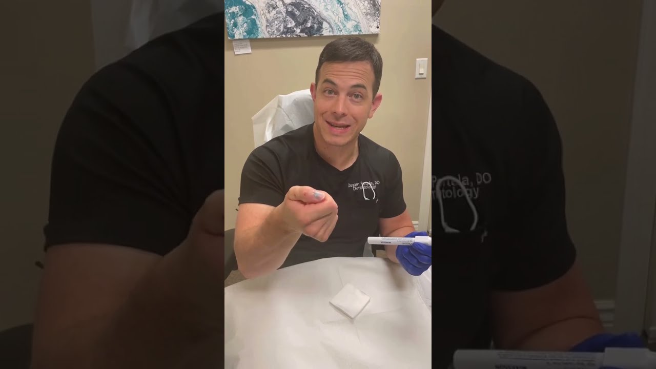 Doctor Puts A Hole In His Own Nail Immediate Relief 208SkinDoc