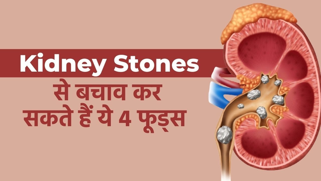 Kidney Stones eat these foods to avoid Kidney Stones Watch Video