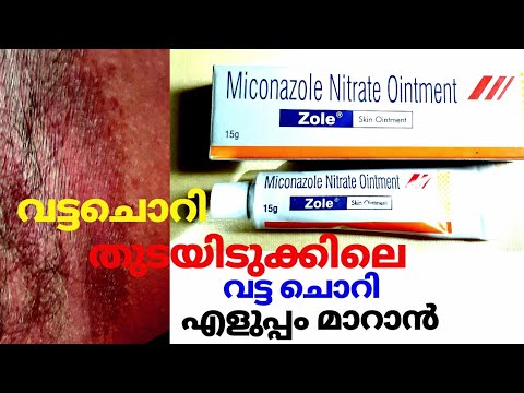 Zole F Skin ointment Review,വട്ട ചൊറി,ചൊറിച്ചൽ പ്പെട്ടന്ന് മാറണോ?