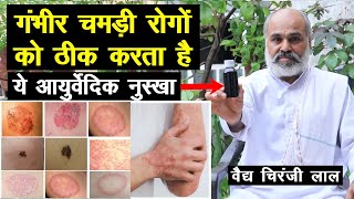 गंभीर चमड़ी रोगों को ठीक करता है ये आयुर्वेदिक नुस्खा, 100% कारगर Skin Disease Natural Treatment screenshot 3