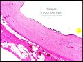 Simple mucinous cyst Pancreas