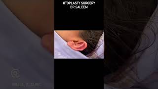 Otoplasty surgery in Pakistan by dr Saleem