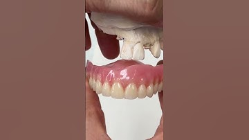 Replacing extracted teeth with a Brand-New Denture