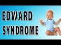 Edward Syndrome - Causes, Symptoms, and Treatment