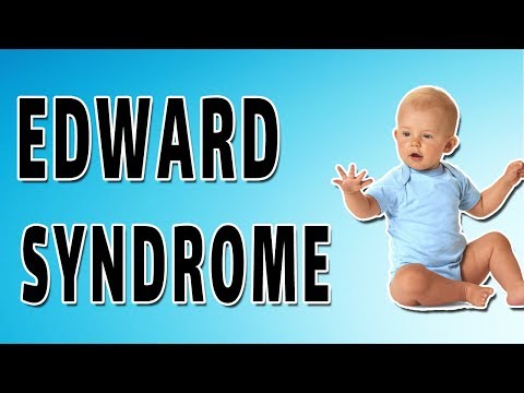 Edward Syndrome - Causes, Symptoms, and Treatment