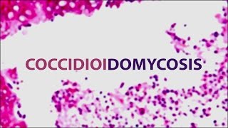 Coccidioidomycosis (Valley Fever) | Pediatric Grand Grounds - Mattel Children's Hospital UCLA screenshot 1