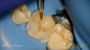 Direct cuspal coverage (overlay) after endodontic treatment