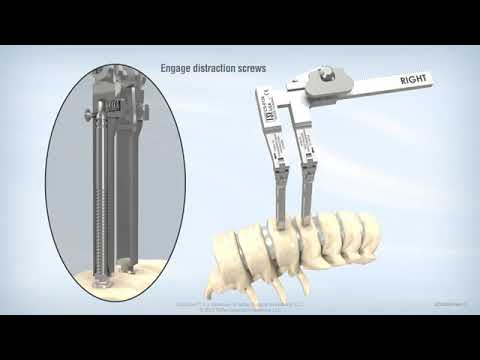 TeDan Surgical Innovations: QuickStart Distraction Screws