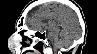 врожденный ангиоматоз КТ головного мозга саггитальная проекция(, 2014-02-19T16:38:19.000Z)