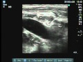 Ultrasound-guided axillary catheter insertion