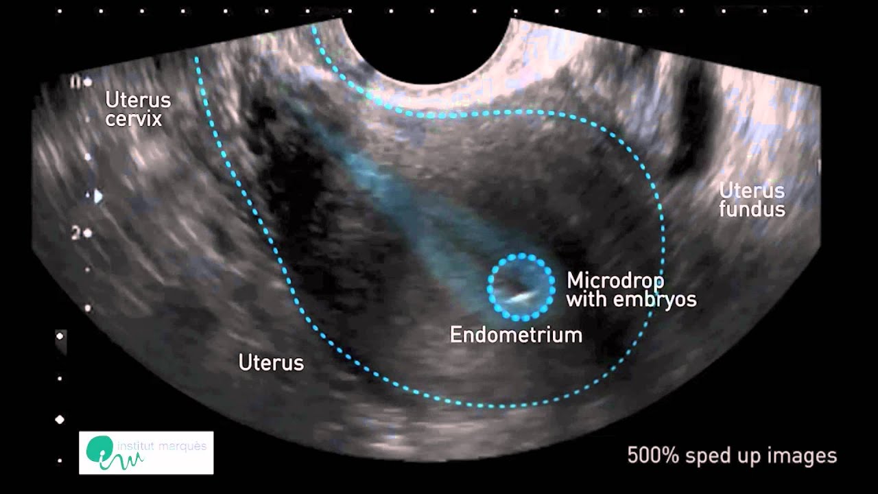 Se reposer après le transfert embryonnaire – Le blog de la fertilité