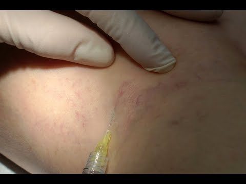 Vidéo: Procédure De Sclérothérapie Veineuse