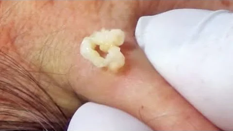 Sebaceous Cyst:  Treatment, Examples, Popping and ...