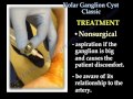 Ganglion Cyst  of the wrist, volar  - Everything You Need To Know - Dr. Nabil Ebraheim