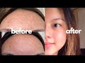 How I FINALLY Cleared My Skin ft. Tiny Bumps | Comedonal Acne | Philippines