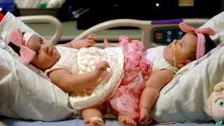 Conjoined Twins Successfully Separated